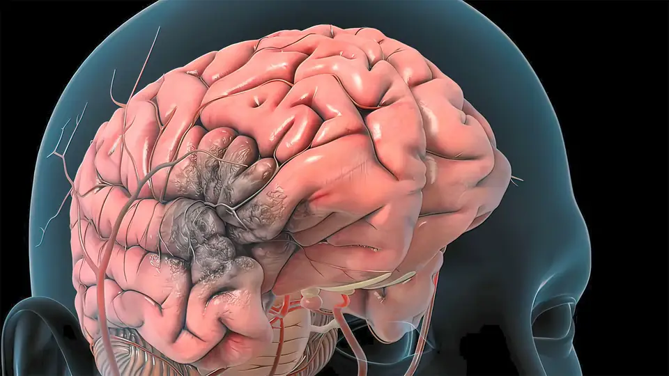 Hypertensive Intracranial Bleed