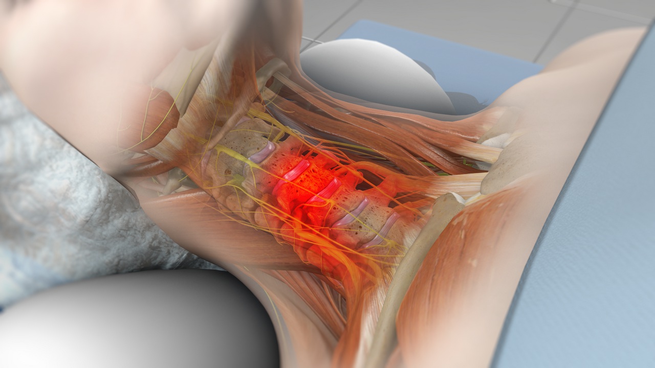 Discectomy and Fusion (ACDF) Treatment in Delhi NCR