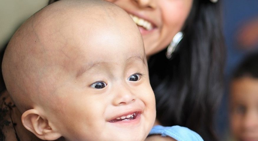 Paediatric and Adult Hydrocephalus