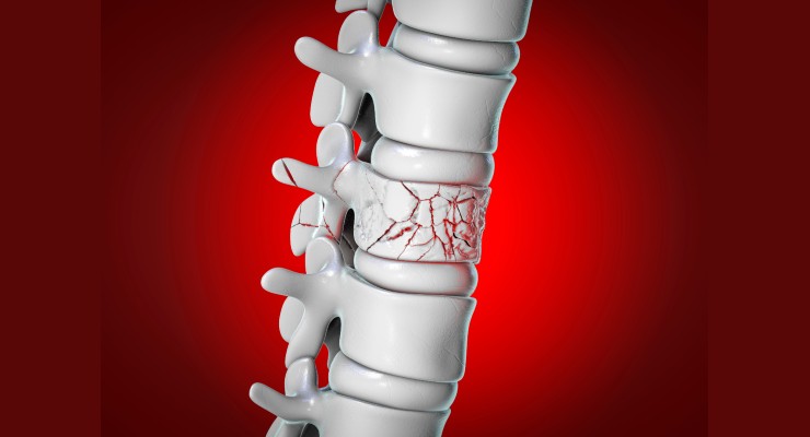 Kyphoplasty Treatment in Delhi NCR
