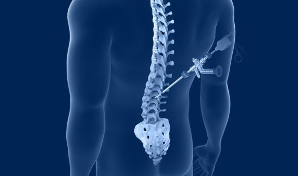 Minimally Invasive Spine Surgery Doctor Delhi NCR