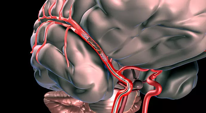 Neurovascular Surgery