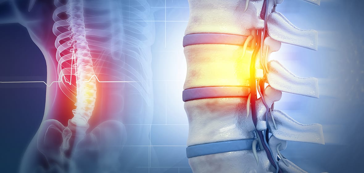 Spinal Cord Injuries