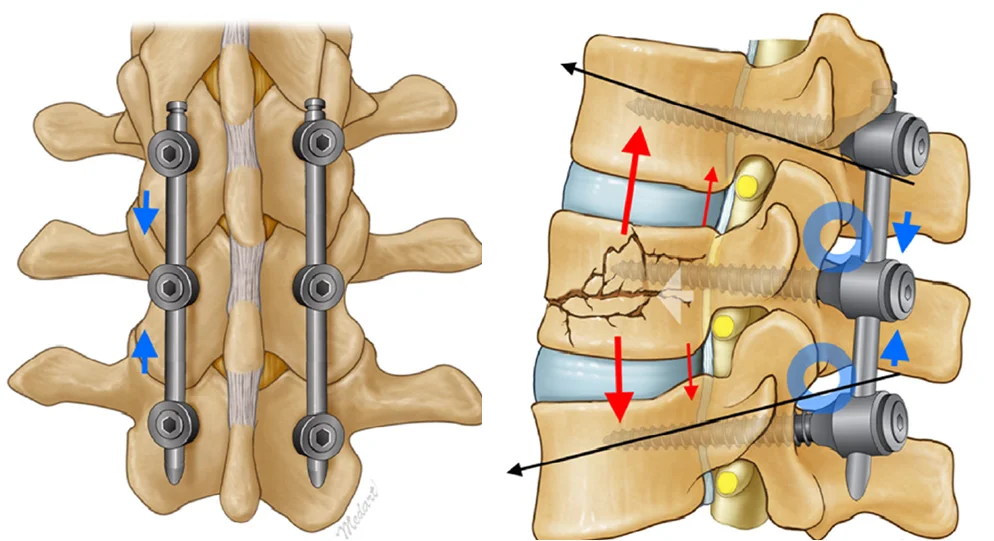 pine Fixation for Fractures in Delhi NCR
