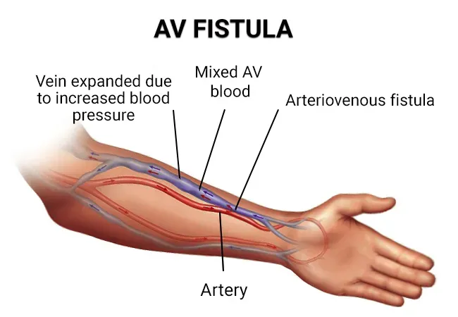 AV Fistula Embolization