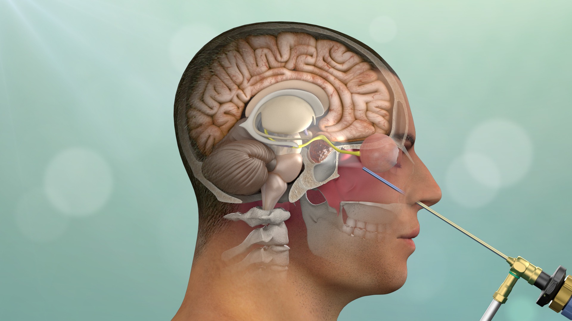 Endoscopic Brain Surgery in Delhi