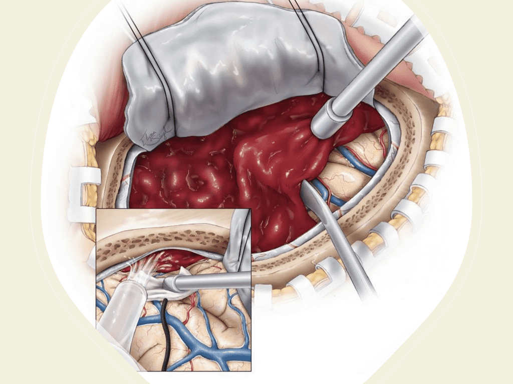 MMA embolization for CSDH