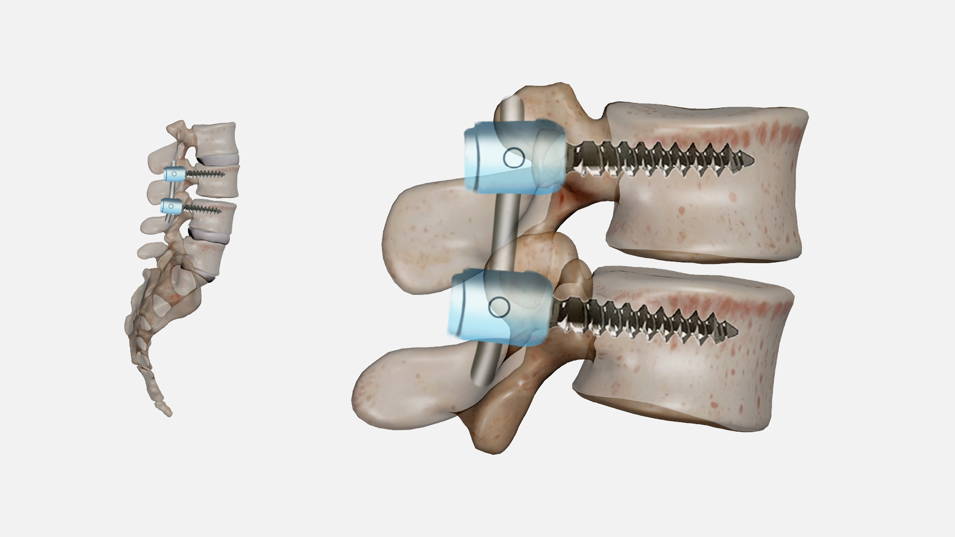 Spine Surgeon Delhi NCR