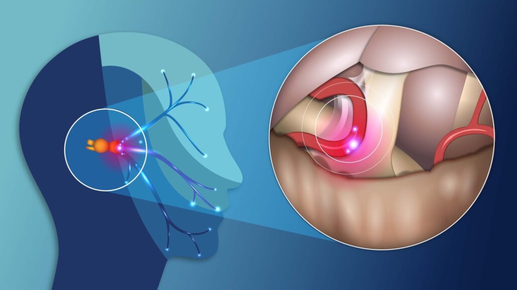 Trigeminal Neuralgia Treatment in Delhi Ncr