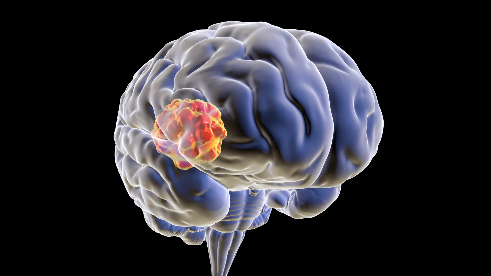 Brain tumour surgery performed with advanced neurosurgical technology