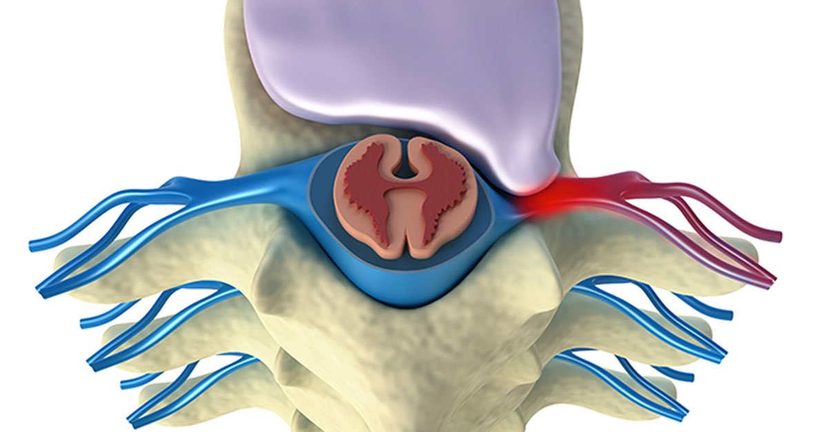 Microdiscectomy minimally invasive spine surgery for slip disc