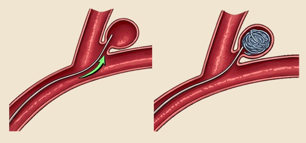 Aneurysm coiling, balloon-assisted coiling and stent-assisted coiling for brain aneurysms