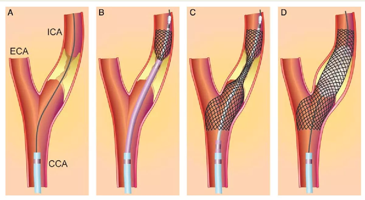 Carotid, vertebral and intracranial stenting to restore blood flow to the brain