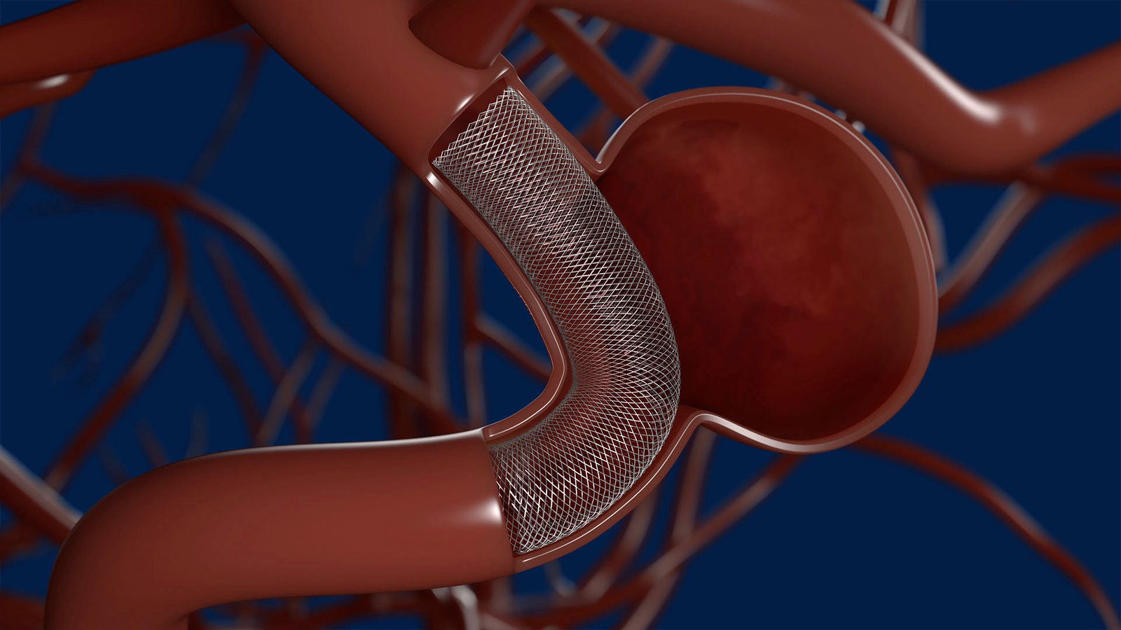 Flow diversion for giant brain aneurysms