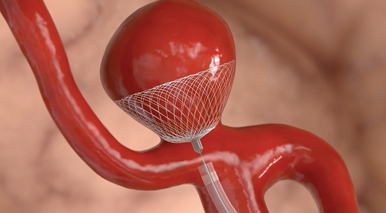 Intrasaccular device placement for brain aneurysms