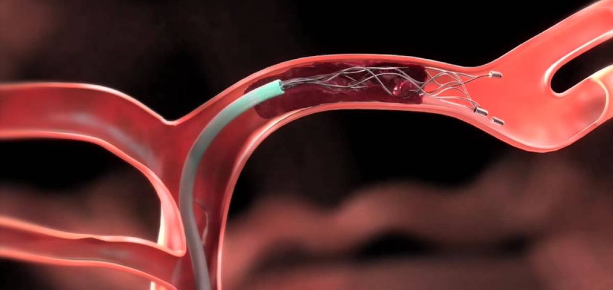 Mechanical thrombectomy for stroke, a minimally invasive clot removal procedure